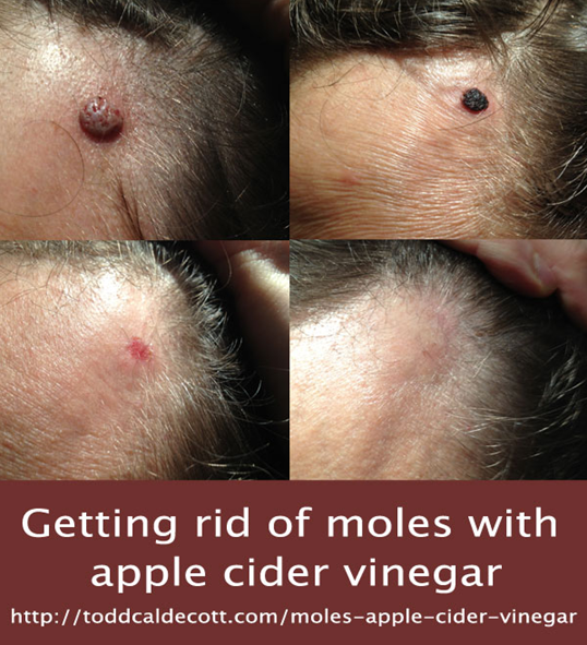 How to get rid of Moles with Apple Cider Vinegar 7.png