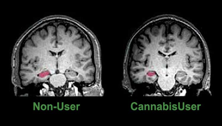 Marijuana’s Long Term Effects On The Brain Finally Revealed.png