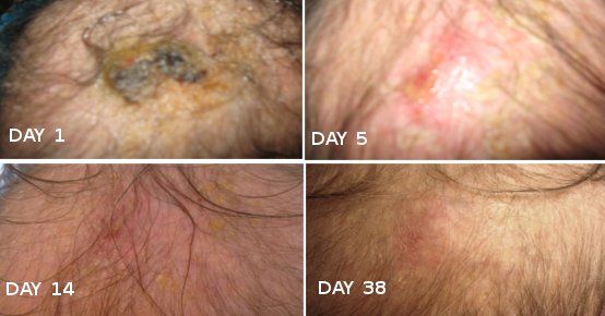 How One Woman Cured Her Skin Cancer At Home – Using Coconut Oil And Baking Soda.png